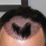 hair transplant turkey