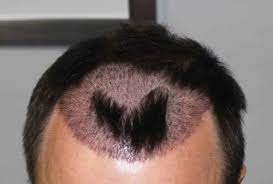 hair transplant turkey