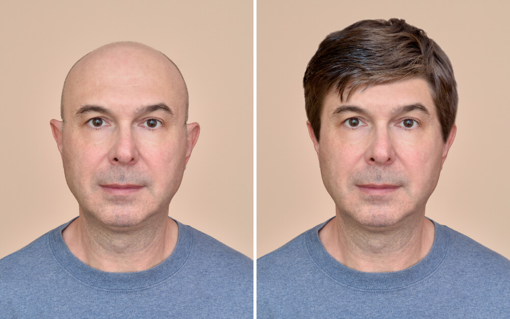example of a Hair Transplant