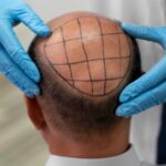 What Are Different Types of Hair Transplants in Turkey